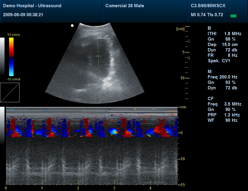 Eco doppler Eco doppler: Color M Se usa en combinación con el doppler color y sirve para detectar de una manera rápida la existencia de arritmias